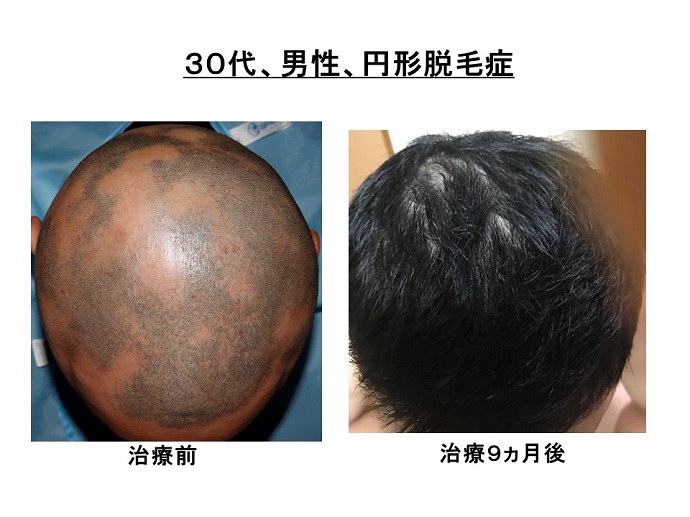 円形脱毛症　病院
